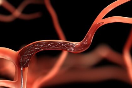 Supernova Stent Retriever device developed by Indian scientists to remove brain blood clots