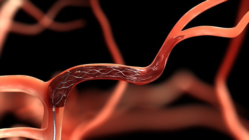 Supernova Stent Retriever device developed by Indian scientists to remove brain blood clots